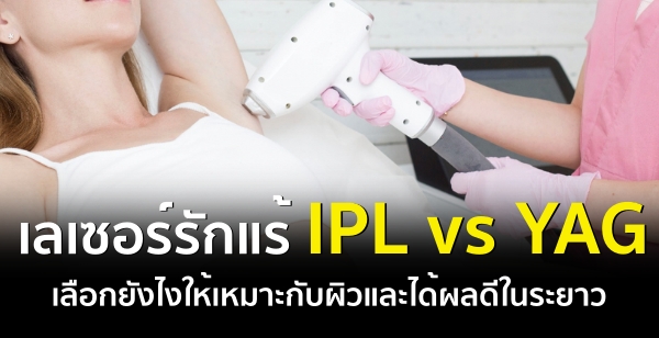 ѡ IPL vs YAG ͡ѧСѺŴ