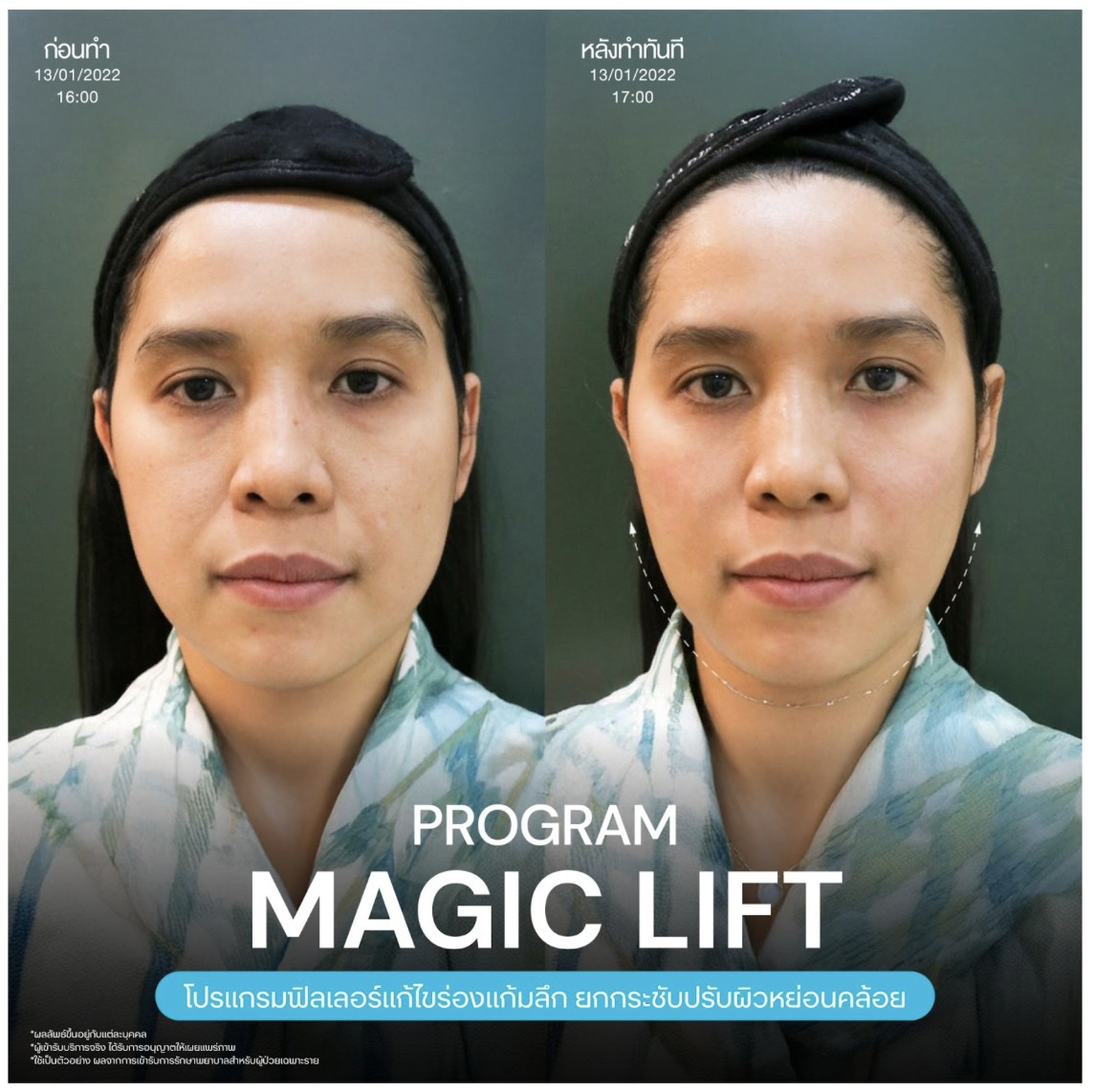 cheek-groove-filler-injection