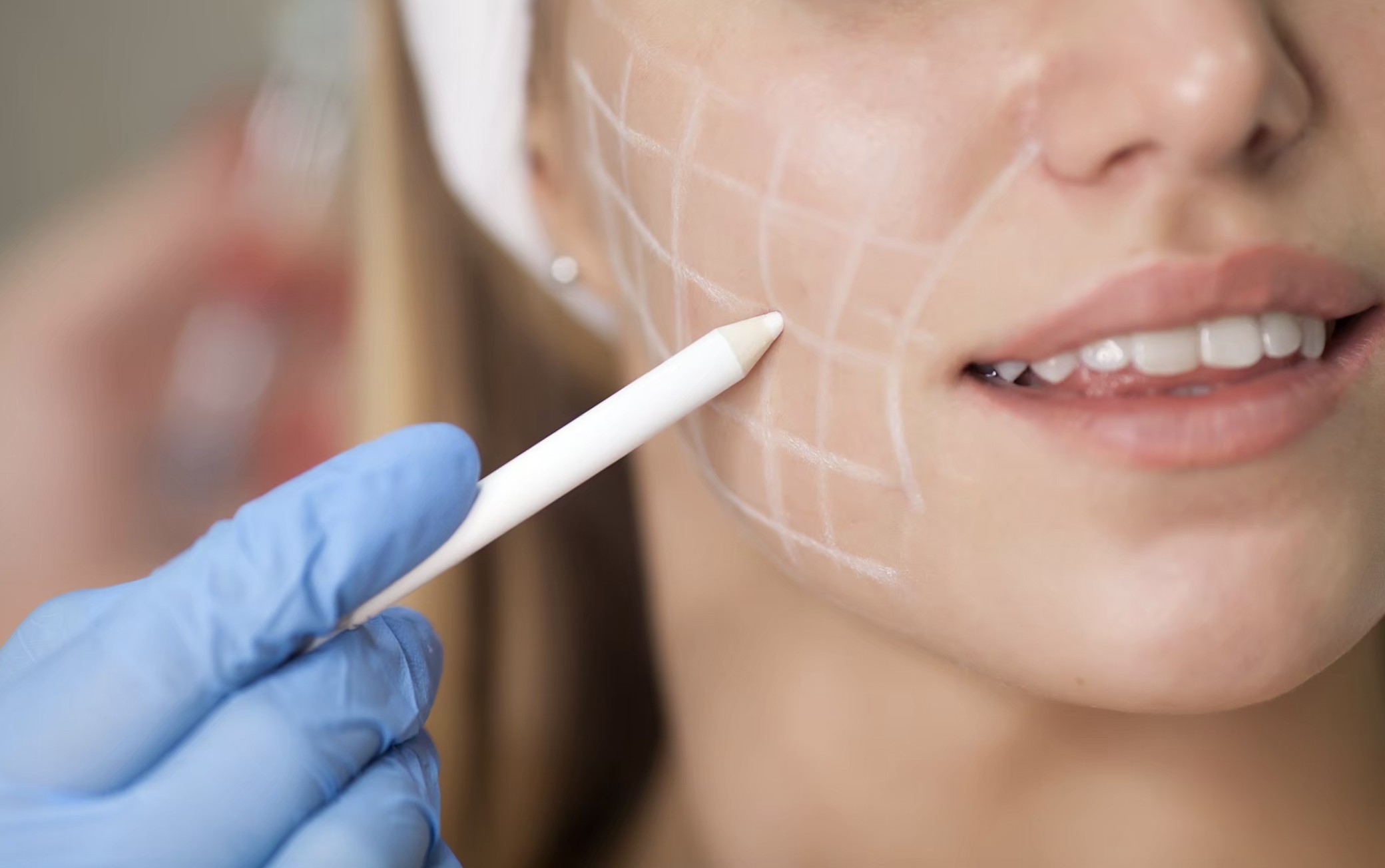 Ultherapy