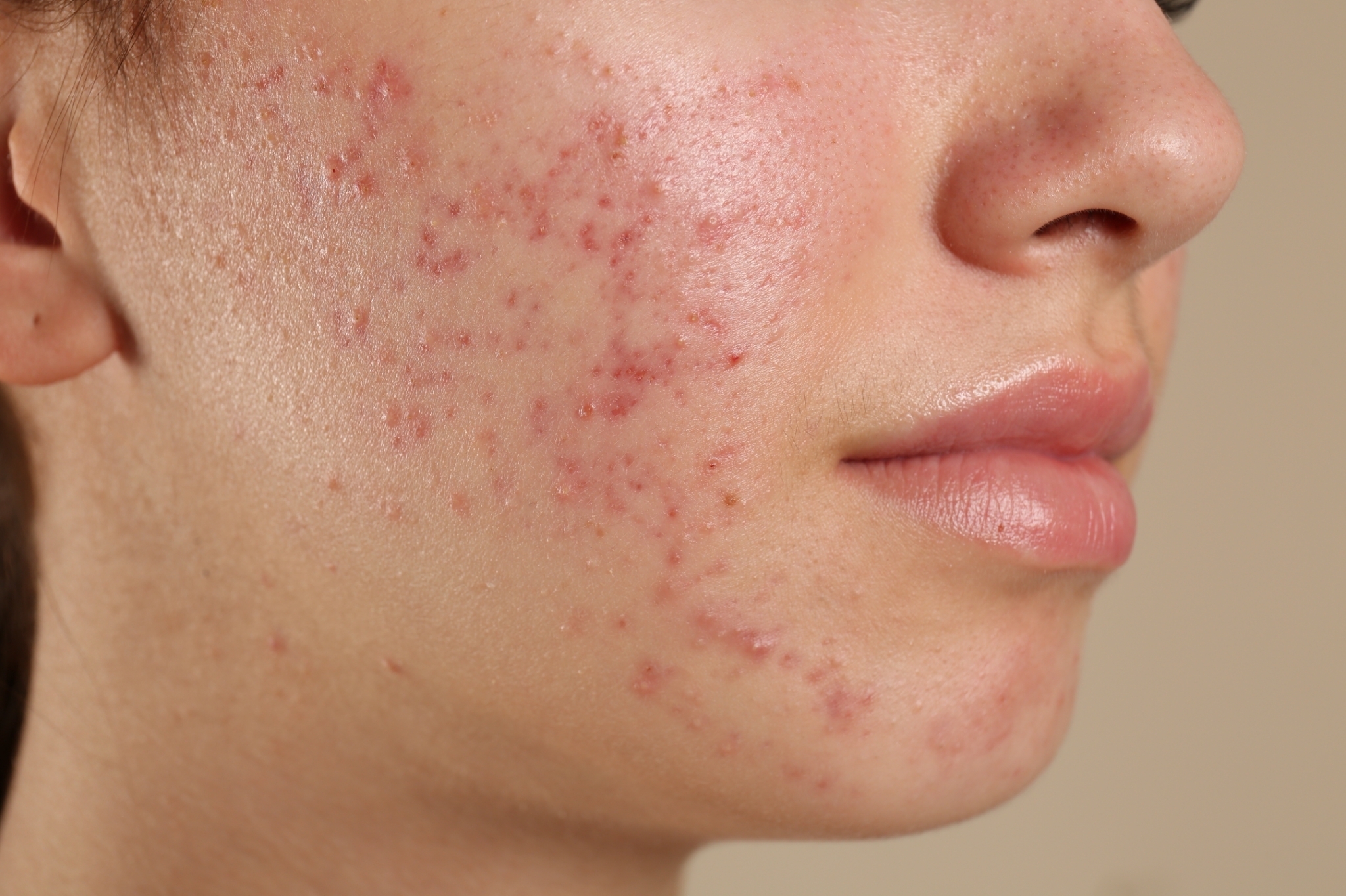 Acne Solution Levels