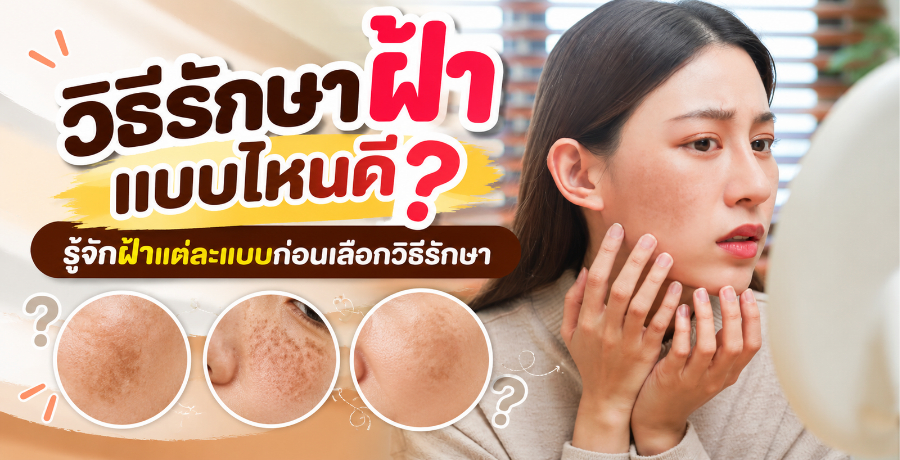วิธีรักษาฝ้าแบบไหนดี? รู้จักฝ้าแต่ละแบบก่อนเลือกวิธีรักษา