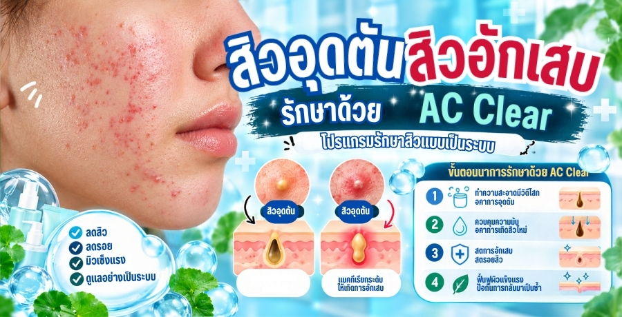 สิวอุดตัน สิวอักเสบรักษาด้วย AC Clear โปรแกรมรักษาสิวแบบเป็นระบบ